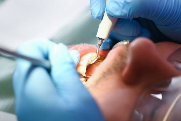 Best Emergency Dental Extractions in Saukville, WI